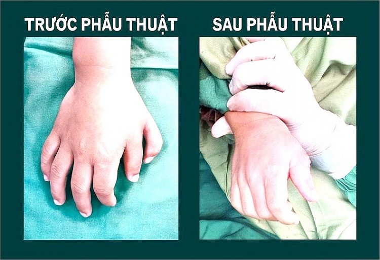 Trung tâm Y tế huyện Lâm Thao (Phú Thọ): Phẫu thuật thành công nhiều ca bệnh khó