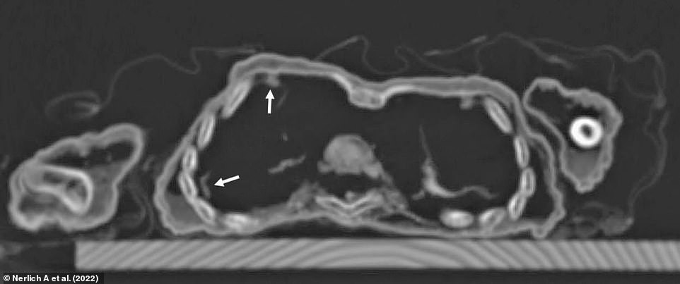Hình ảnh từ máy chụp cắt lớp CT (Ảnh: Nerlich et al., Frontiers, 2022)
