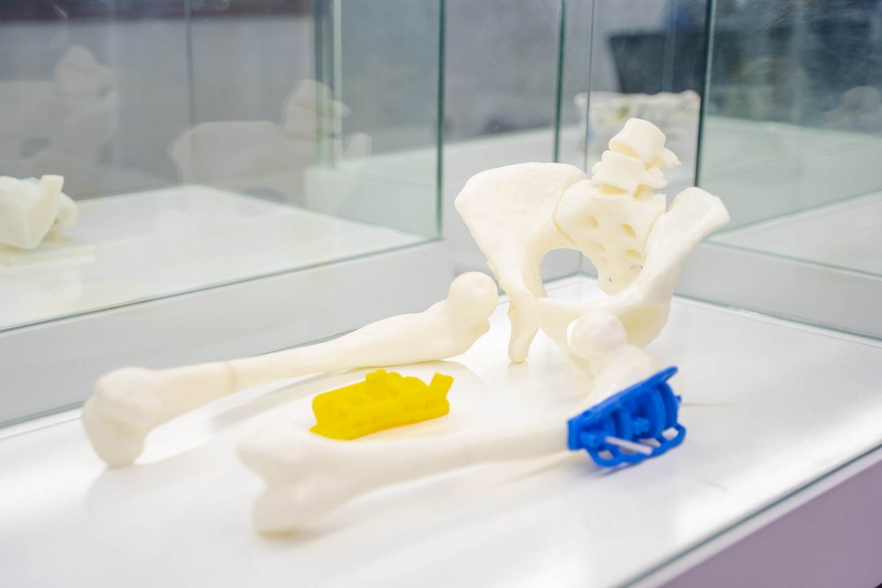 Hình ảnh minh họa trợ cụ dẫn đường phẫu thuật được nghiên cứu và phát triển độc quyền tại Trung tâm Công nghệ 3D trong Y học VinUni, được ứng dụng thành công để phẫu thuật một ca bệnh biến dạng nặng xương đùi.
