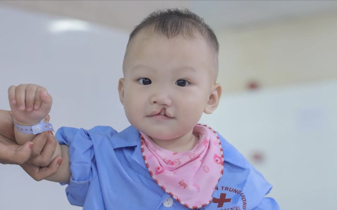 Phẫu thuật miễn phí cho trẻ em có dị tật miệng tại Thừa Thiên-Huế