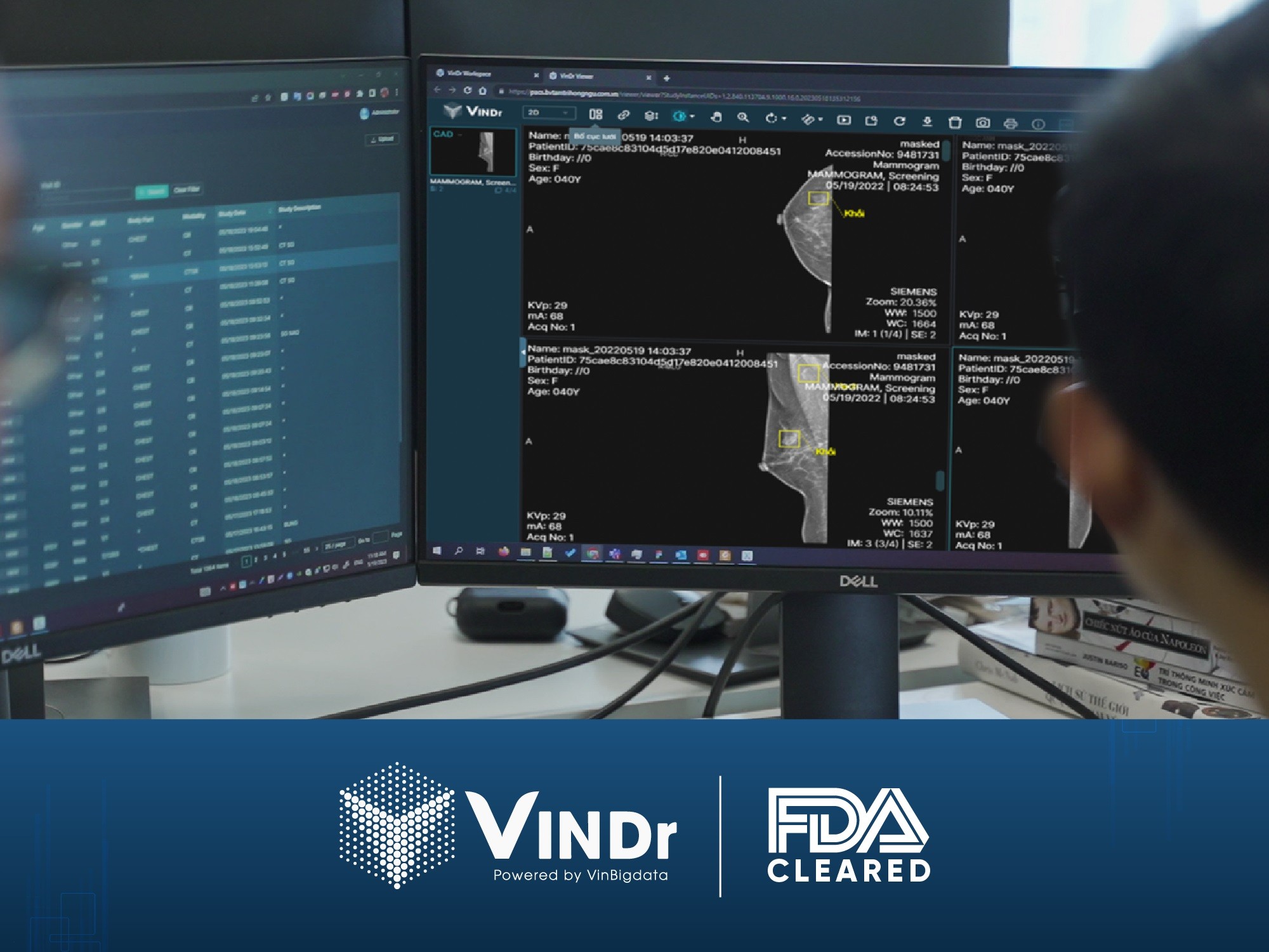 VinDr trở thành sản phẩm AI cho chẩn đoán X-quang tuyến vú đầu tiên và duy nhất tại Việt Nam được FDA công nhận