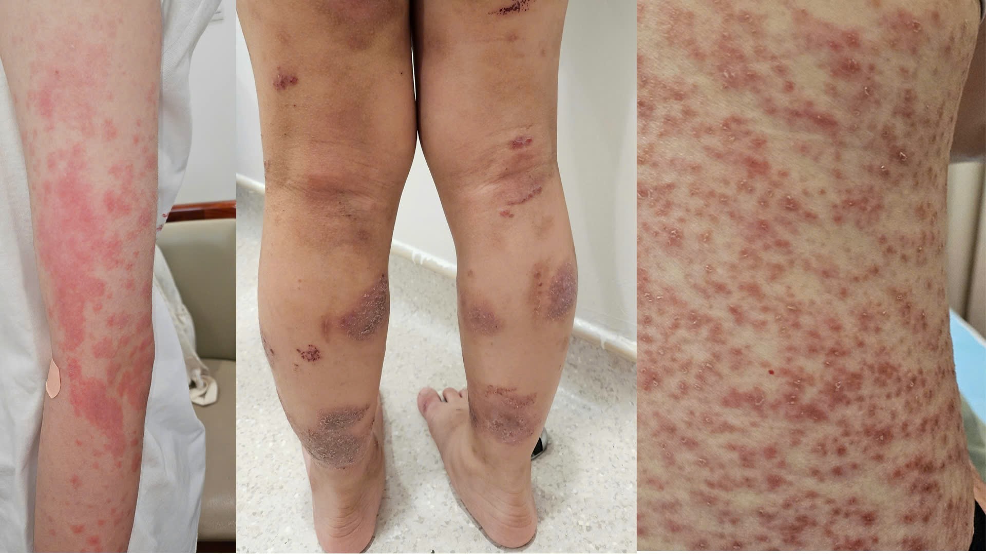 Trường hợp các bệnh liên quan đến dị ứng đến thăm khám tại Vinmec