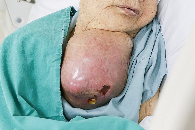 Bóc thành công khối u quái gần 2kg chèn ép vùng cổ cụ bà 81 tuổi Bóc thành công khối u quái gần 2kg chèn ép vùng cổ cụ bà 81 tuổi