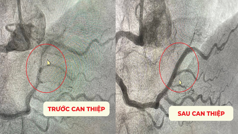 Cần Thơ: Can thiệp thành công ca tái hẹp nặng trong stent mạch vành đã đặt ở nước ngoài