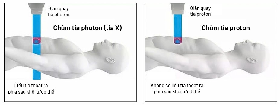 Xạ trị photon (tia X) đưa liều xạ vào khối u nhưng vẫn có thể “xuyên qua” phía sau, gây tổn thương mô lành quanh đường đi của tia; xạ trị proton hiện đại với tia năng lượng biết “dừng đúng chỗ” ngay vị trí khối u để tiêu diệt khối u hiệu quả và an toàn cao. Ảnh: Bệnh viện Đa khoa Tâm Anh Xạ trị photon (tia X) đưa liều xạ vào khối u nhưng vẫn có thể “xuyên qua” phía sau, gây tổn thương mô lành quanh đường đi của tia; xạ trị proton hiện đại với tia năng lượng biết “dừng đúng chỗ” ngay vị trí khối u để tiêu diệt khối u hiệu quả và an toàn cao. Ảnh: Bệnh viện Đa khoa Tâm Anh