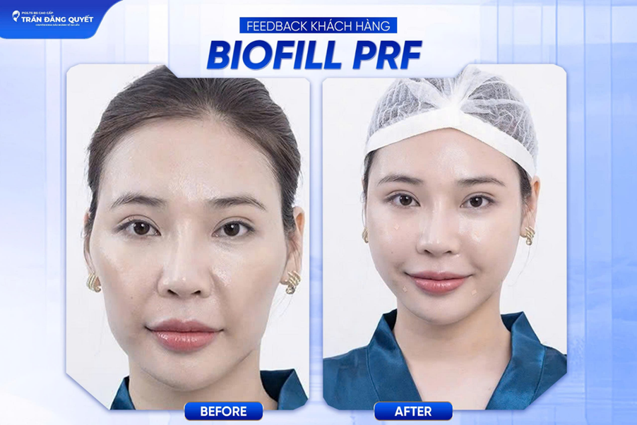 Kết quả sau khi cân chỉnh gương mặt bằng phương pháp BIOFILL PRF