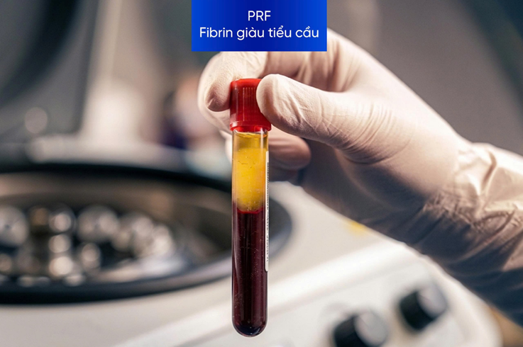 giai phap biofill prf trong can chinh guong mat tu than