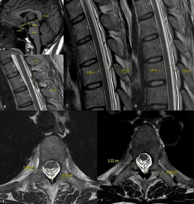Hình ảnh MRI trước và sau thủ thuật vá máu ngoài màng cứng (EBP). Sau điều trị, khoang chứa dịch não tủy quanh tủy sống được mở rộng trở lại, trong khi khoang ngoài màng cứng thu hẹp rõ rệt. Những thay đổi này cho thấy áp lực dịch não tủy đã được cải thiện sau thủ thuật. 