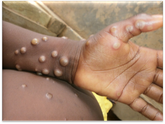 WHO cảnh báo virus gây bệnh đậu mùa khỉ tiếp tục lây lan