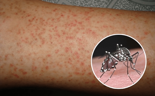 WHO cảnh báo nguy cơ nhầm lẫn sốt xuất huyết với COVID-19 và các bệnh khác