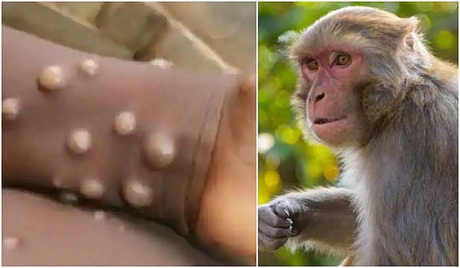 Việt Nam đang giám sát chặt chẽ để ngăn ngừa bệnh đậu mùa khỉ xâm nhập