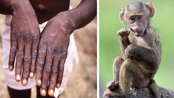 WHO: đậu mùa khỉ chưa phải là tình trạng khẩn cấp y tế toàn cầu
