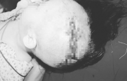 Hà Nội: Bé gái 2 tuổi bị chó nuôi cắn rách mặt, lộ xương sọ
