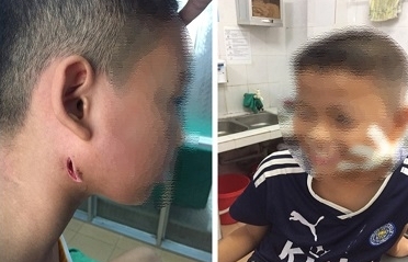 phat hien 3 tre nhiem vi khuan an thit nguoi o nghe an