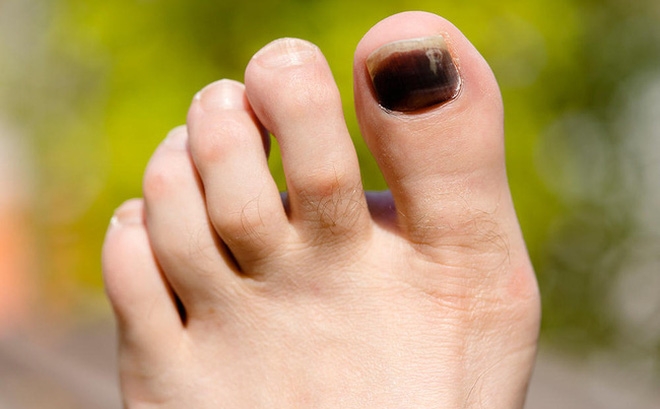 “Nếu bạn thấy dấu hiệu bệnh móng chân đen như: đau, sưng, hoặc khó di chuyển các ngón chân thì đây chính là thời điểm để đến bệnh viện để được chẩn đoán và điều trị kịp thời.”