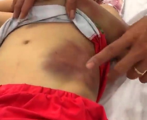 Bé trai 6 tuổi bị mẹ bạo hành dã man ở Tây Ninh
