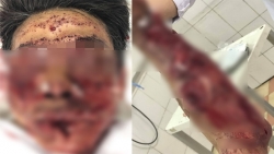 Hà Nam: Người đàn ông bị nổ nát mặt vì dùng pháo tự chế đón Tết