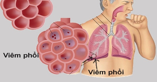 viem phoi do virus la o trung quoc bo y te khuyen cao cach phong chong lay nhiem