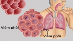 viem phoi do virus la van chua co thuoc dac tri