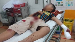 Gia Lai: Làm pháo tự chế bằng bột diêm, nam sinh bị thương nặng