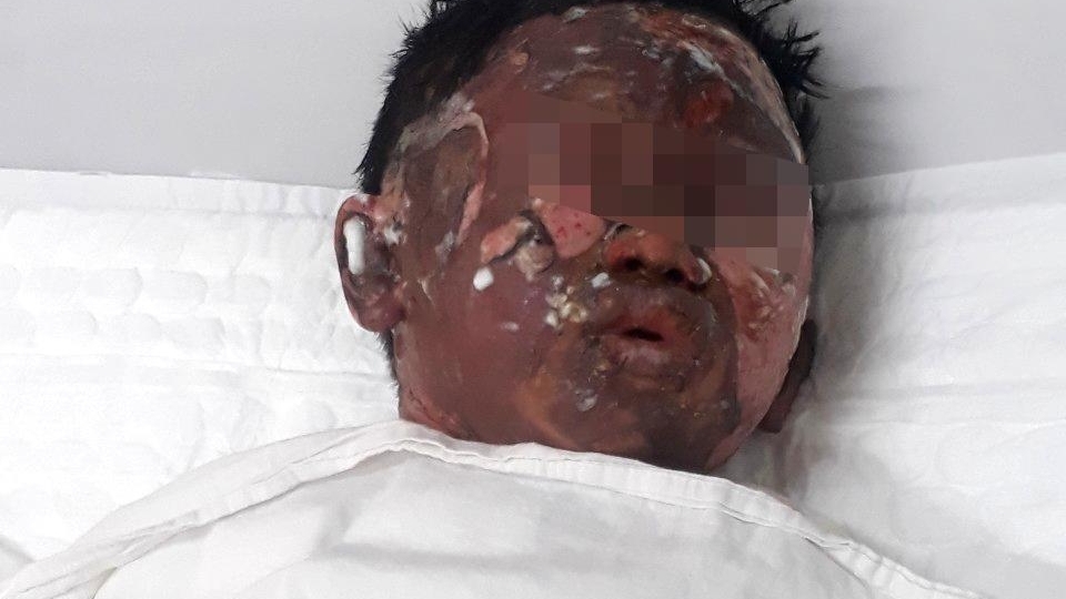 Tình hình sức khỏe bé 6 tuổi bị dì ruột tưới xăng thiêu sống ở Vũng Tàu