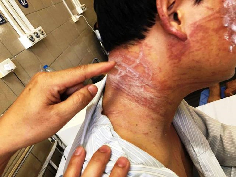 Hà Nội: Nam thanh niên bị hoại tử da vì bỏng sứa lửa ha noi nam thanh nien bi hoai tu da vi bong sua lua