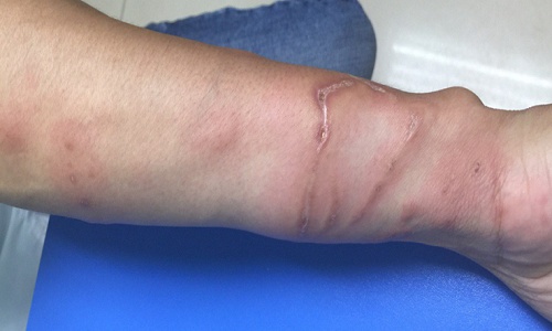 Hà Nội: Nam thanh niên bị hoại tử da vì bỏng sứa lửa ha noi nam thanh nien bi hoai tu da vi bong sua lua