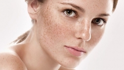 4 sai lầm nhiều người mắc khi chăm sóc da sau đốt tàn nhang