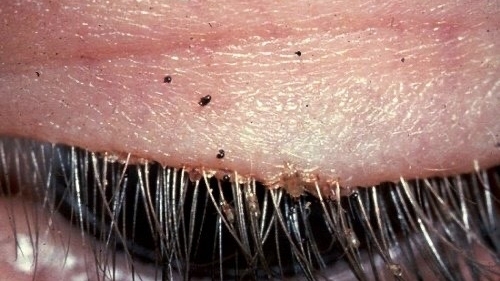 Gần 100 kí sinh trùng rận mu làm tổ trên mi mắt nam bệnh nhân