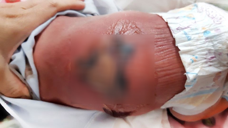 ho than suoi am be 8 ngay tuoi nguy kich vi bong va nhiem trung mau