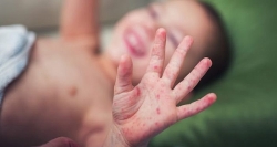 Những việc cha mẹ bắt buộc phải làm khi trẻ bị tay chân miệng để tránh biến chứng nguy hiểm