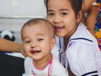 Tháng 3: Operation Smile Việt Nam sẽ phẫu thuật miễn phí cho 200 trẻ em dị tật bẩm sinh hở môi, hàm ếch