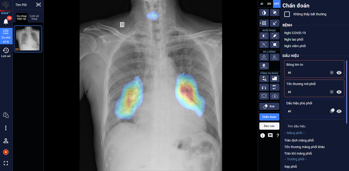 DrAid có thể hỗ trợ chẩn đoán tới tiên lượng điều trị COVID 19 dựa trên ảnh X-quang ngực thẳng