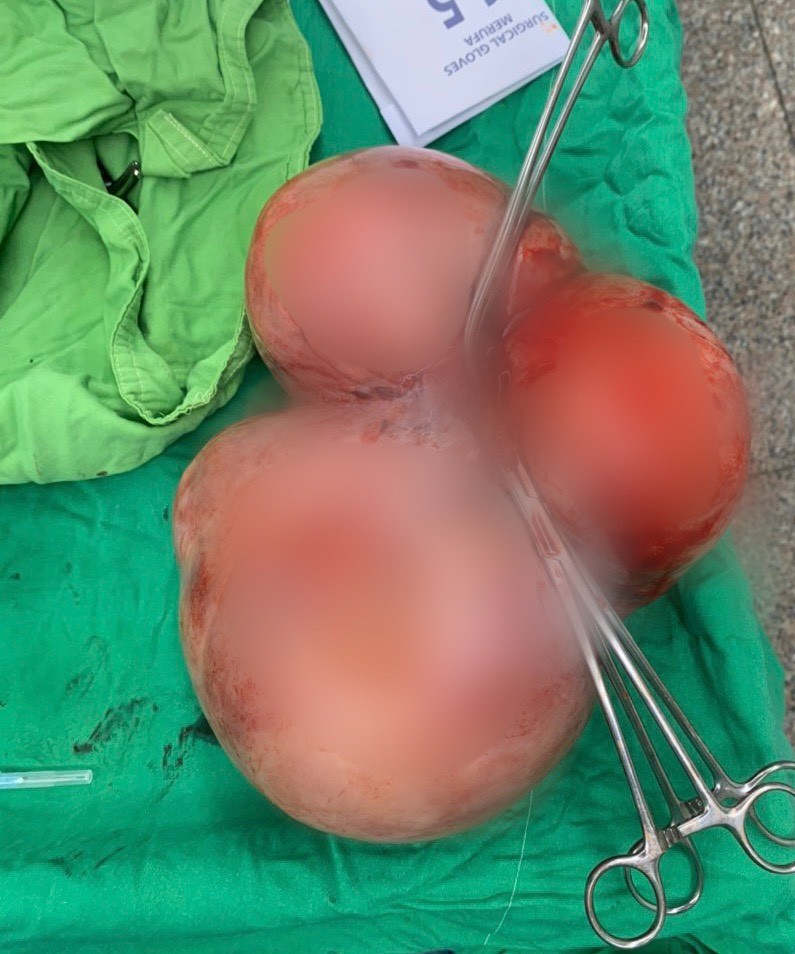 Cần Thơ: Phẫu thuật thành công khối U xơ tử cung “khủng 5,5 kg”