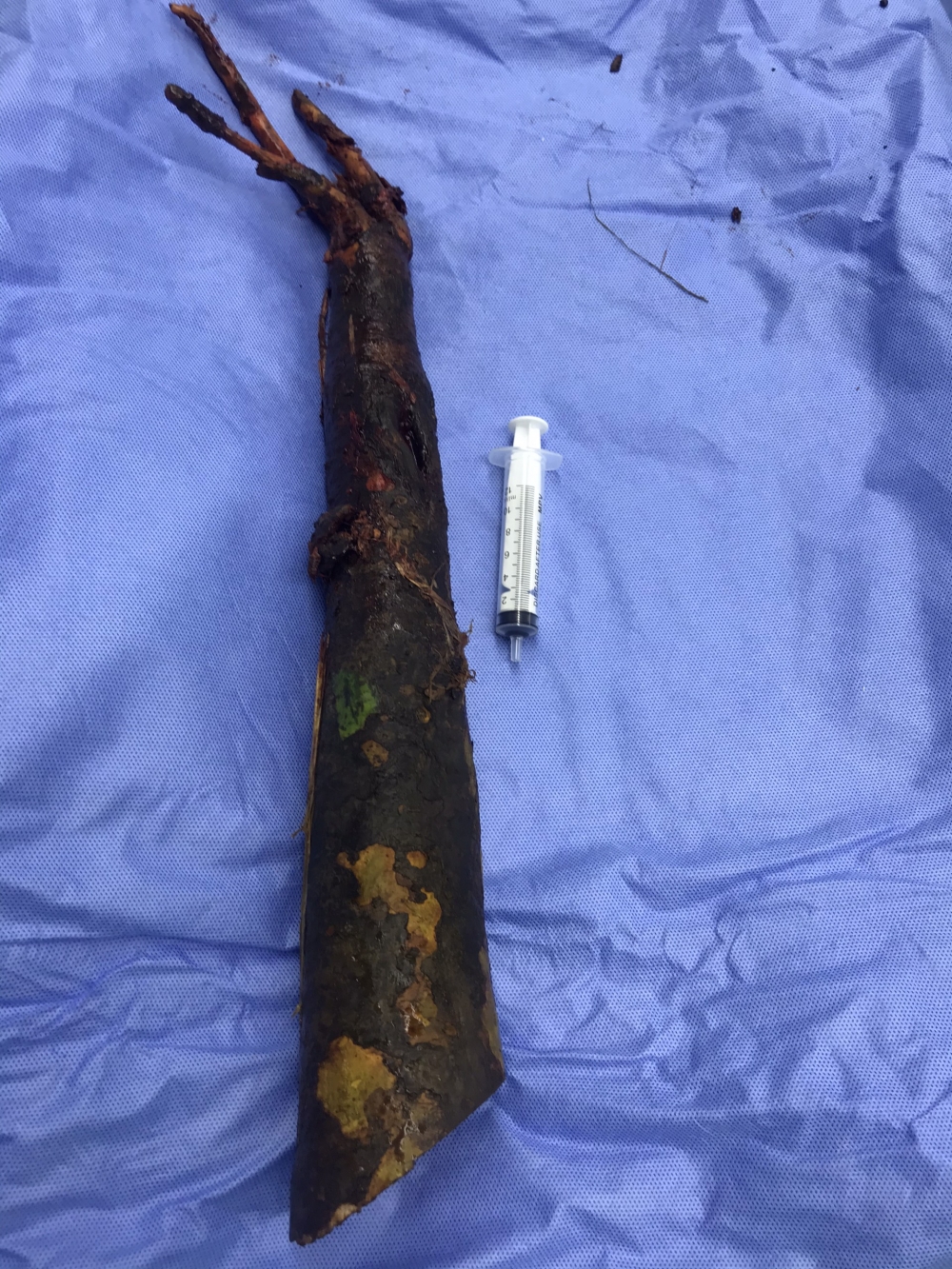 Cần Thơ: Cứu sống bệnh nhân bị cọc bần dài 80cm đâm xuyên vùng hạ vị