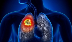 20.000 trường hợp tử vong vì ung thư phổi tại Việt Nam mỗi năm