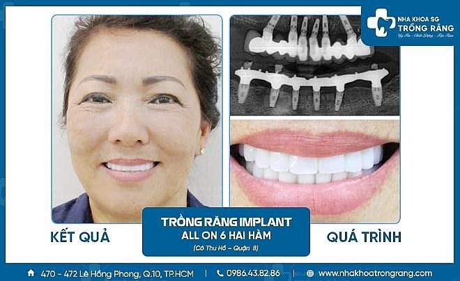Nha khoa trồng răng Sài Gòn – Địa chỉ trồng răng uy tín, chất lượng