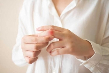 benh lupus ban do nhung dieu can biet