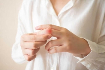 Bệnh lupus ban đỏ: Những điều cần biết