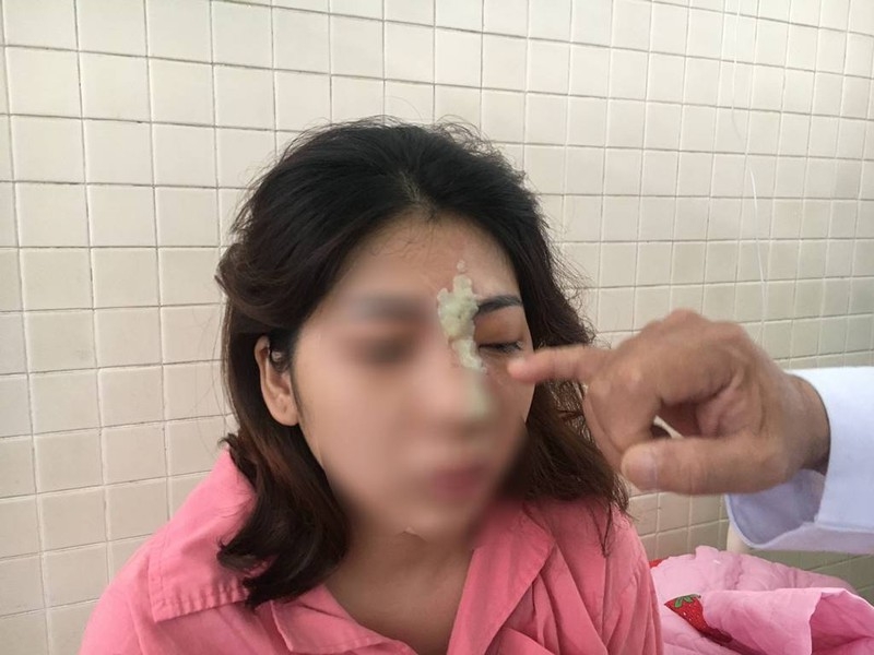 tiem filler nang mui thieu nu 21 tuoi o binh phuoc bi mu mat