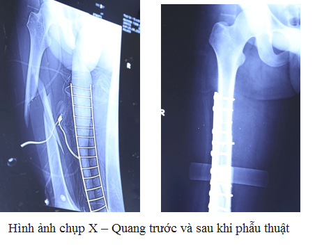 phu tho trung tam y te huyen ha hoa dieu tri thanh cong nhieu ca benh kho