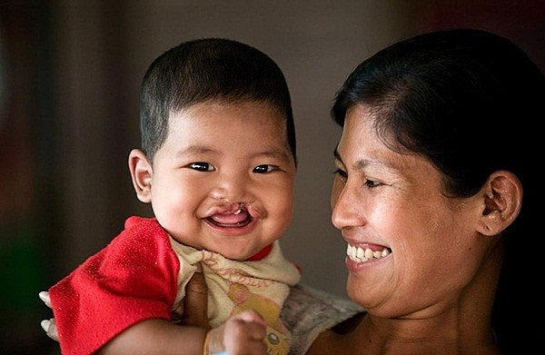 Hàng ngàn trẻ em đã được Operation Smile phẫu thuật miễn phí
