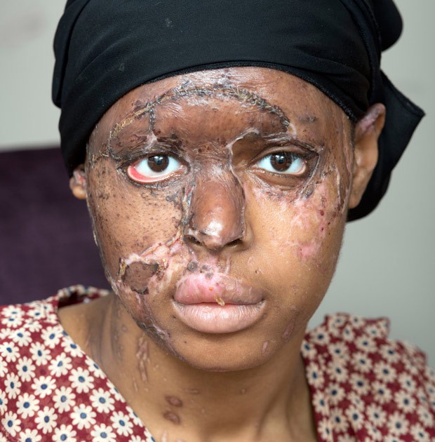 ghen ti vi ban than dep hon minh co gai nhan tam dung axit huy hoai dung nhan ban de tra thu