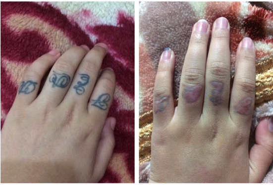 dan mang chia se chuyen di xoa xam dau mot lan roi thoi nhung de lai vet seo xau xi ca doi