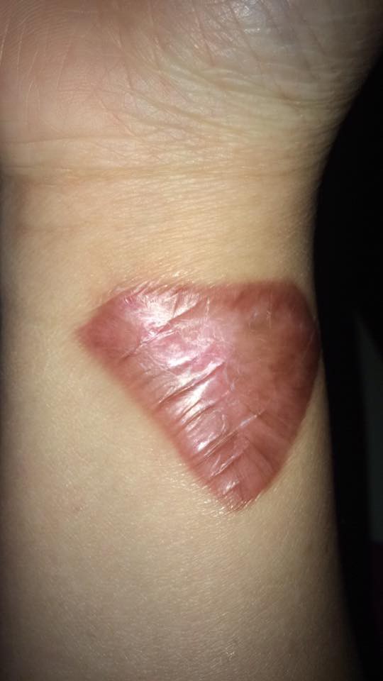 dan mang chia se chuyen di xoa xam dau mot lan roi thoi nhung de lai vet seo xau xi ca doi