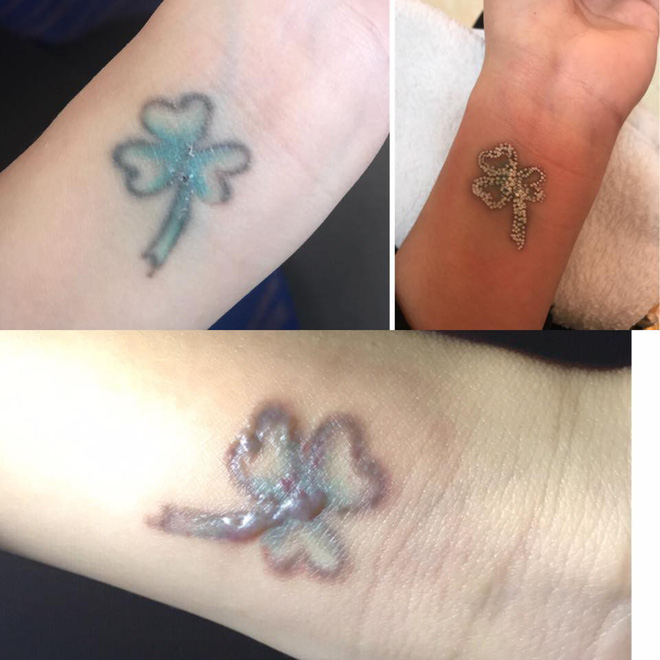 dan mang chia se chuyen di xoa xam dau mot lan roi thoi nhung de lai vet seo xau xi ca doi