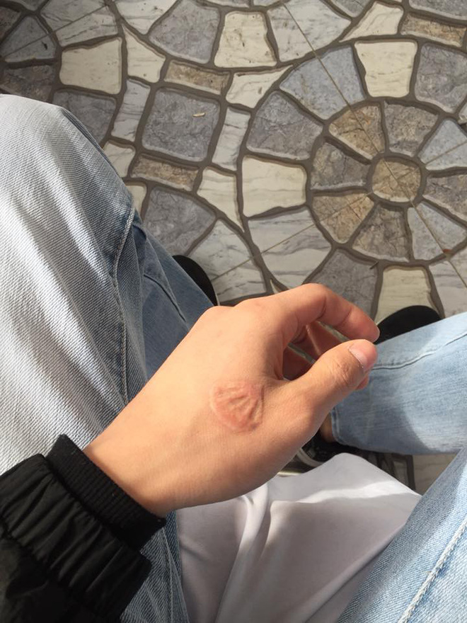 dan mang chia se chuyen di xoa xam dau mot lan roi thoi nhung de lai vet seo xau xi ca doi