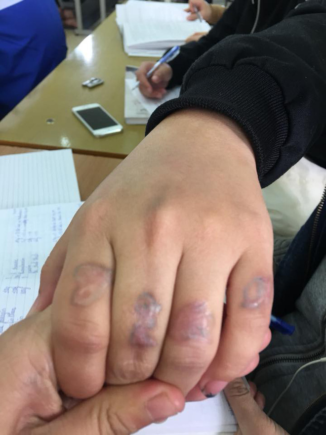 dan mang chia se chuyen di xoa xam dau mot lan roi thoi nhung de lai vet seo xau xi ca doi