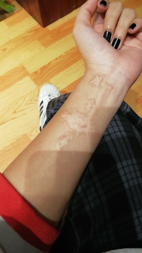 dan mang chia se chuyen di xoa xam dau mot lan roi thoi nhung de lai vet seo xau xi ca doi