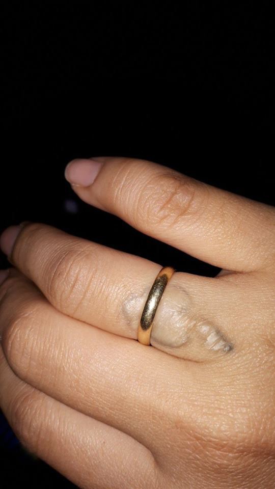 dan mang chia se chuyen di xoa xam dau mot lan roi thoi nhung de lai vet seo xau xi ca doi